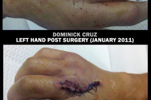 Dominick Cruz now has a Matching set of Bionic Hands (pictures)